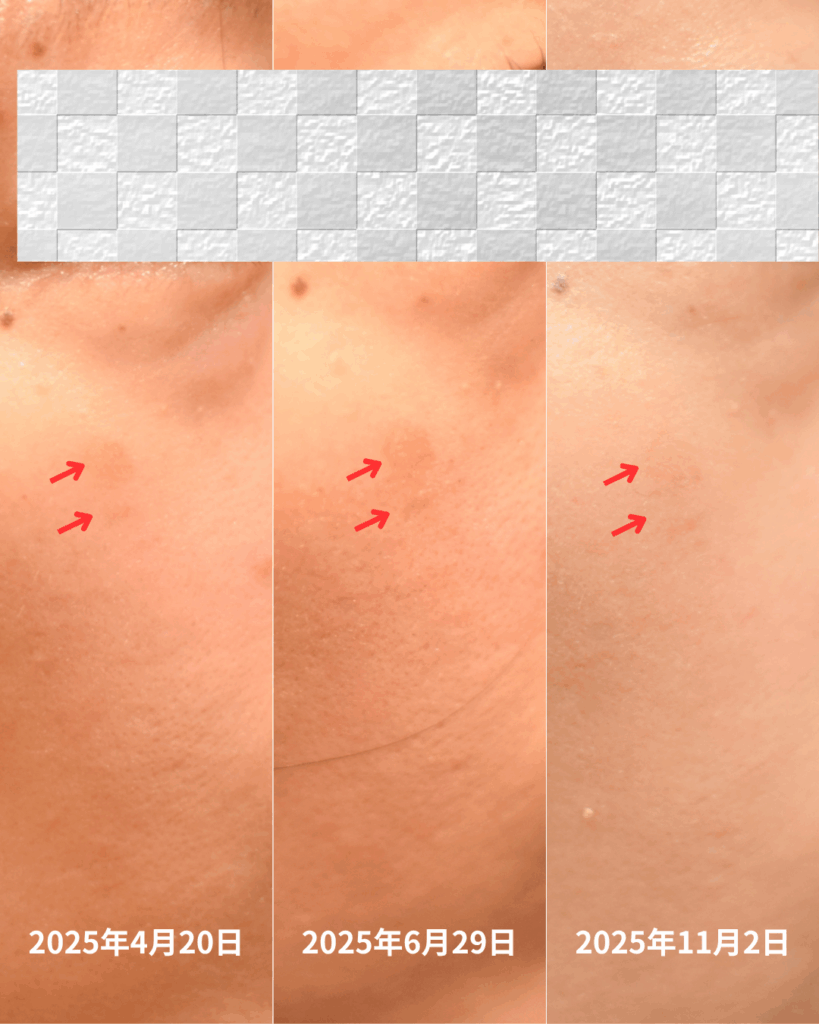 美容鍼灸　シミ改善　ビフォーアフター